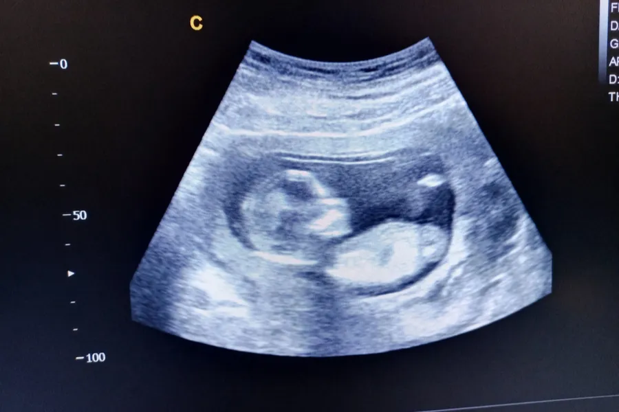 Ultrasound scan of 15 week-old baby.?w=200&h=150